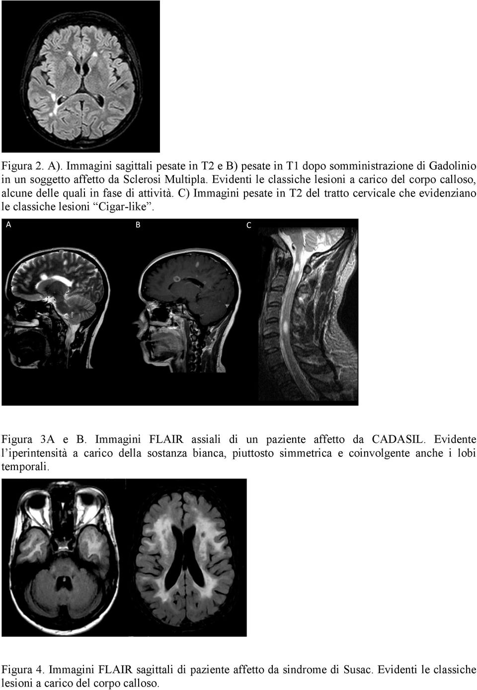 C) Immagini pesate in T2 del tratto cervicale che evidenziano le classiche lesioni Cigar-like. Figura 3A e B.