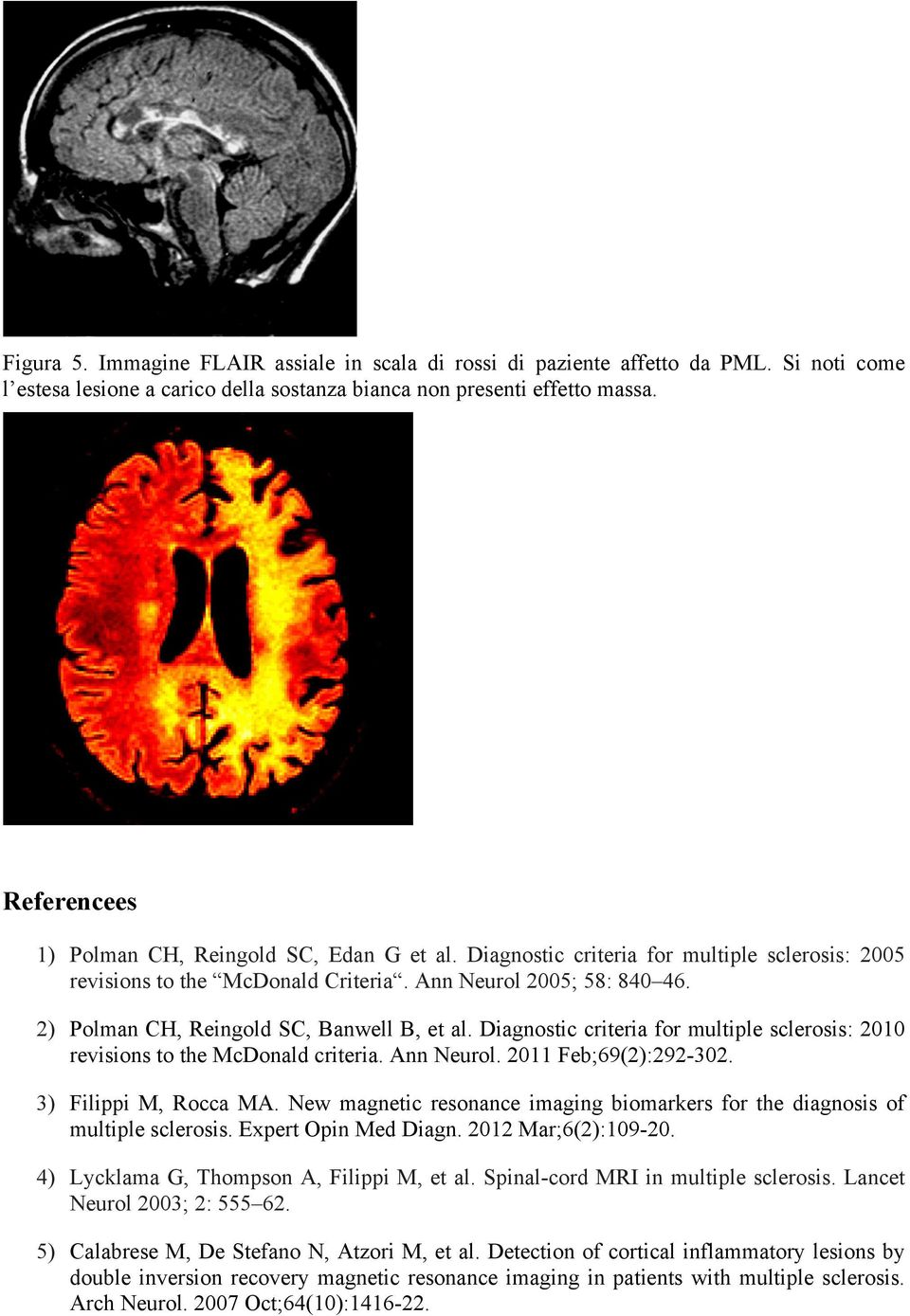 2) Polman CH, Reingold SC, Banwell B, et al. Diagnostic criteria for multiple sclerosis: 2010 revisions to the McDonald criteria. Ann Neurol. 2011 Feb;69(2):292-302. 3) Filippi M, Rocca MA.