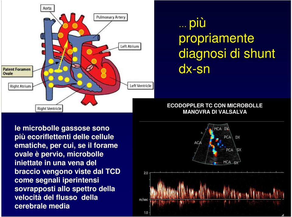 forame ovale è pervio, microbolle iniettate in una vena del braccio vengono viste dal TCD