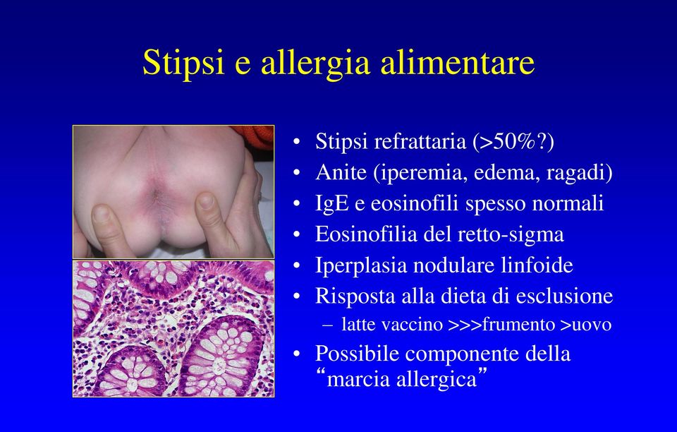 Eosinofilia del retto-sigma Iperplasia nodulare linfoide Risposta alla