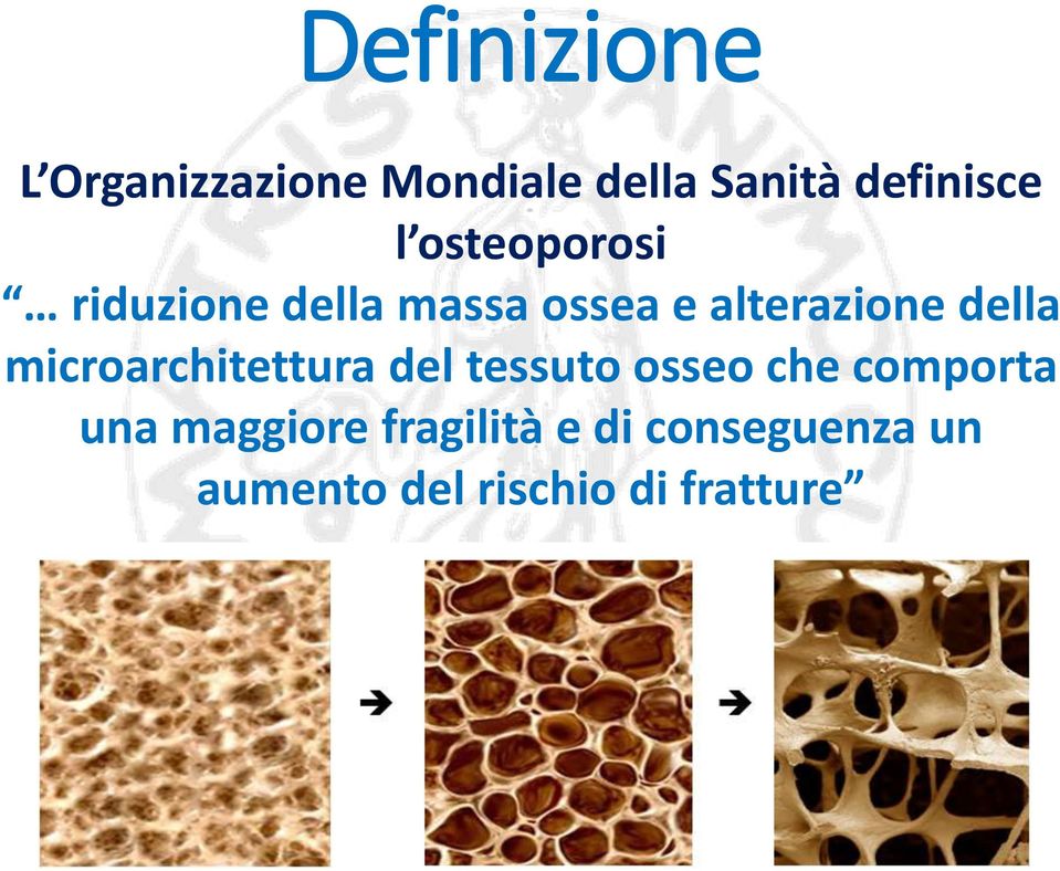 microarchitettura del tessuto osseo che comporta una maggiore