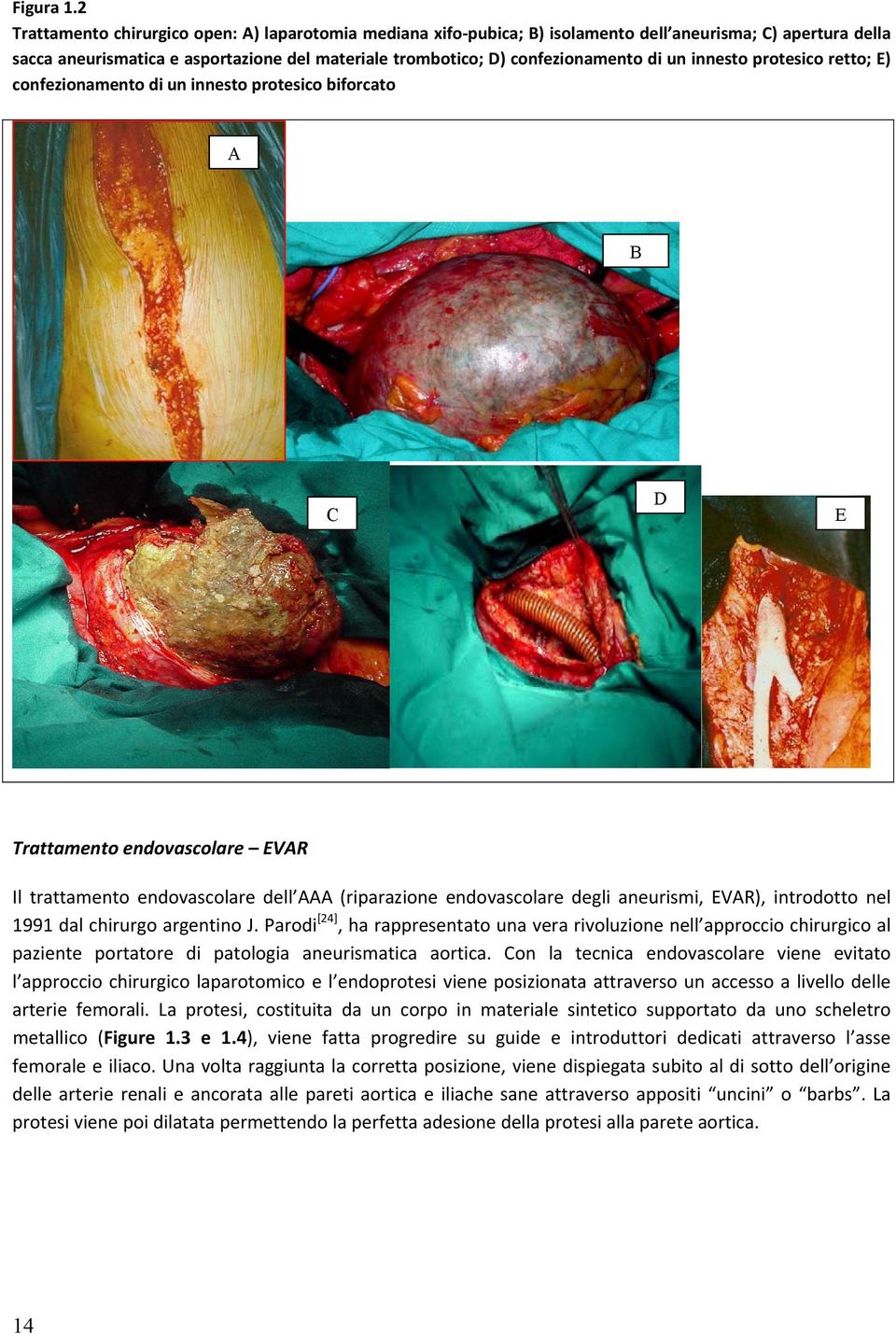un innesto protesico retto; E) confezionamento di un innesto protesico biforcato A B C D E Trattamento endovascolare EVAR Il trattamento endovascolare dell AAA (riparazione endovascolare degli