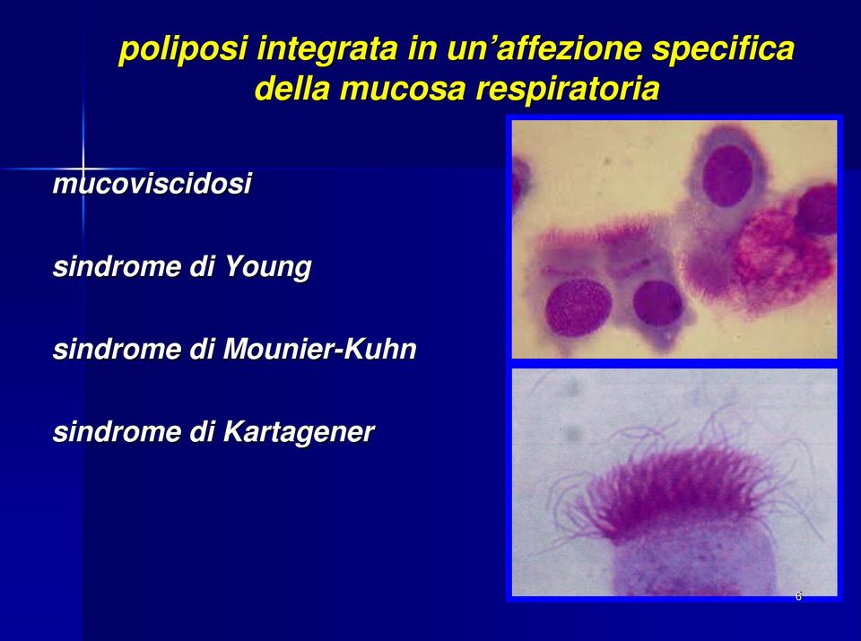 mucoviscidosi sindrome di Young