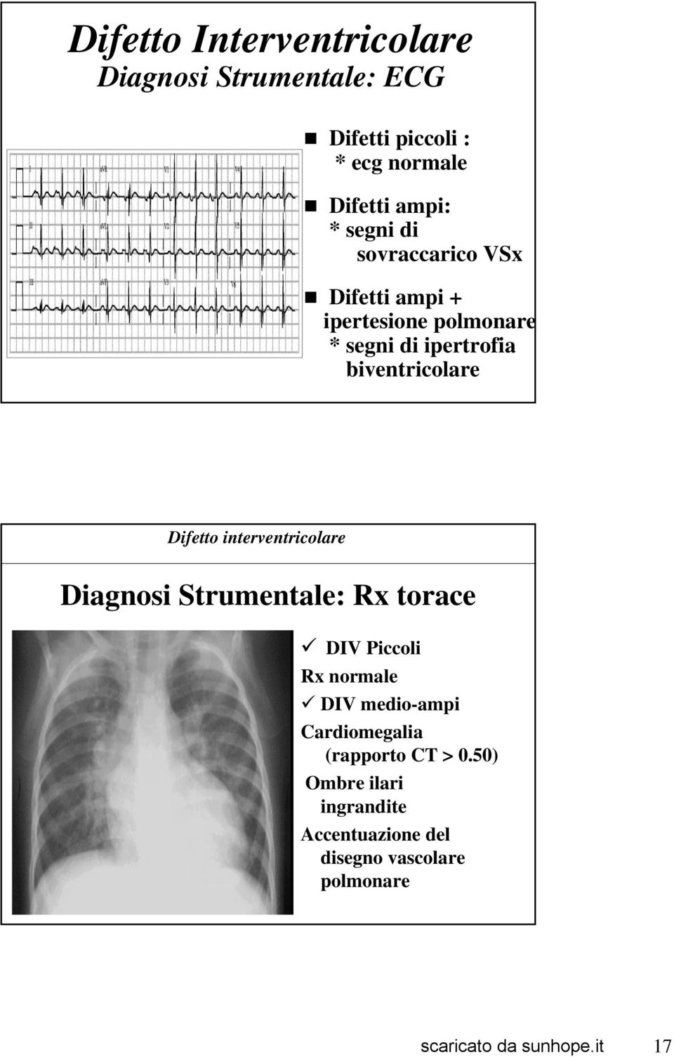 Difetto interventricolare Diagnosi Strumentale: Rx torace DIV Piccoli Rx normale DIV medio-ampi