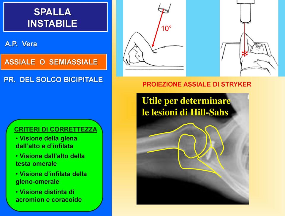 di Hill-Sahs CRITERI DI CORRETTEZZA Visione della glena dall alto e d infilata