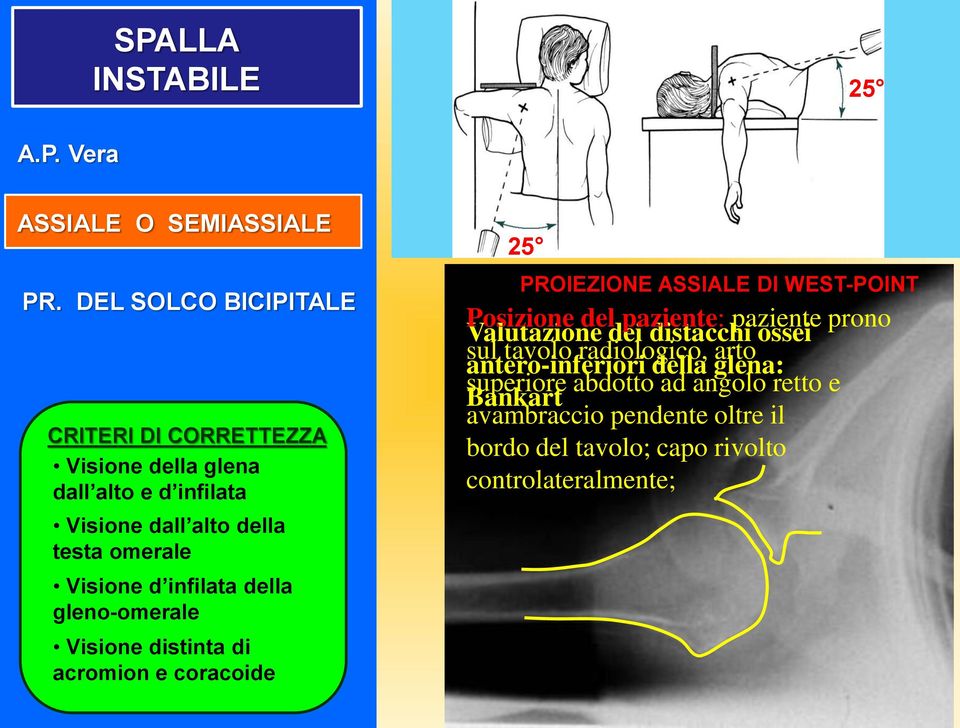 infilata della gleno-omerale Visione distinta di acromion e coracoide 25 PROIEZIONE ASSIALE DI WEST-POINT Posizione del paziente: