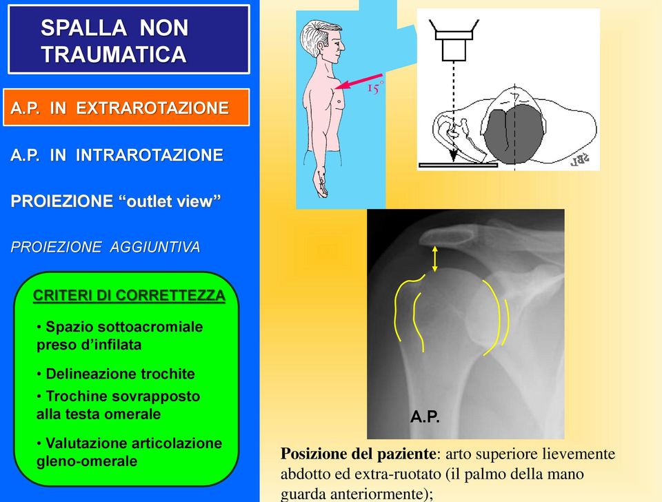 trochite Trochine sovrapposto alla testa omerale Valutazione articolazione gleno-omerale A.P.