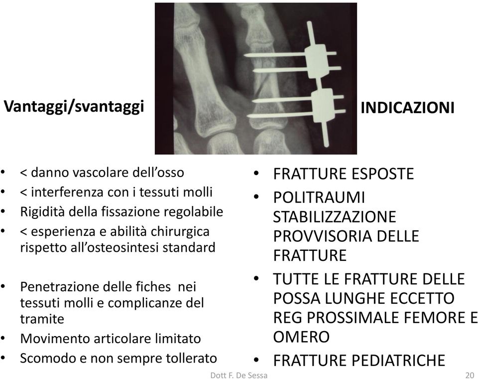 complicanze del tramite Movimento articolare limitato Scomodo e non sempre tollerato FRATTURE ESPOSTE POLITRAUMI STABILIZZAZIONE