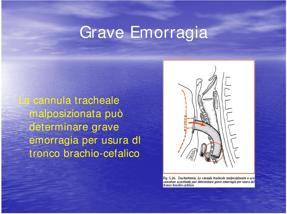 determinare grave emorragia per