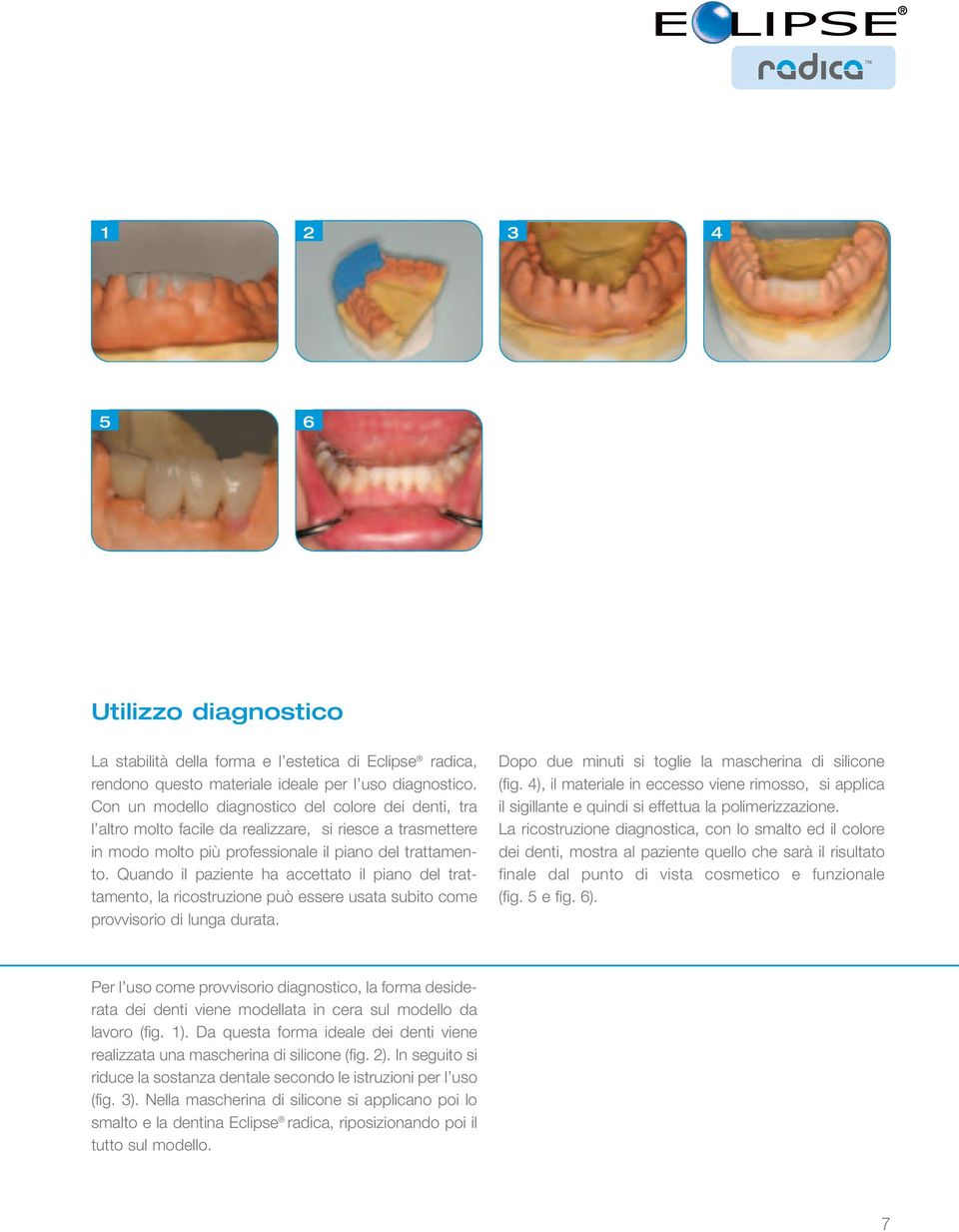 Quando il paziente ha accettato il piano del trattamento, la ricostruzione può essere usata subito come provvisorio di lunga durata. Dopo due minuti si toglie la mascherina di silicone (fig.