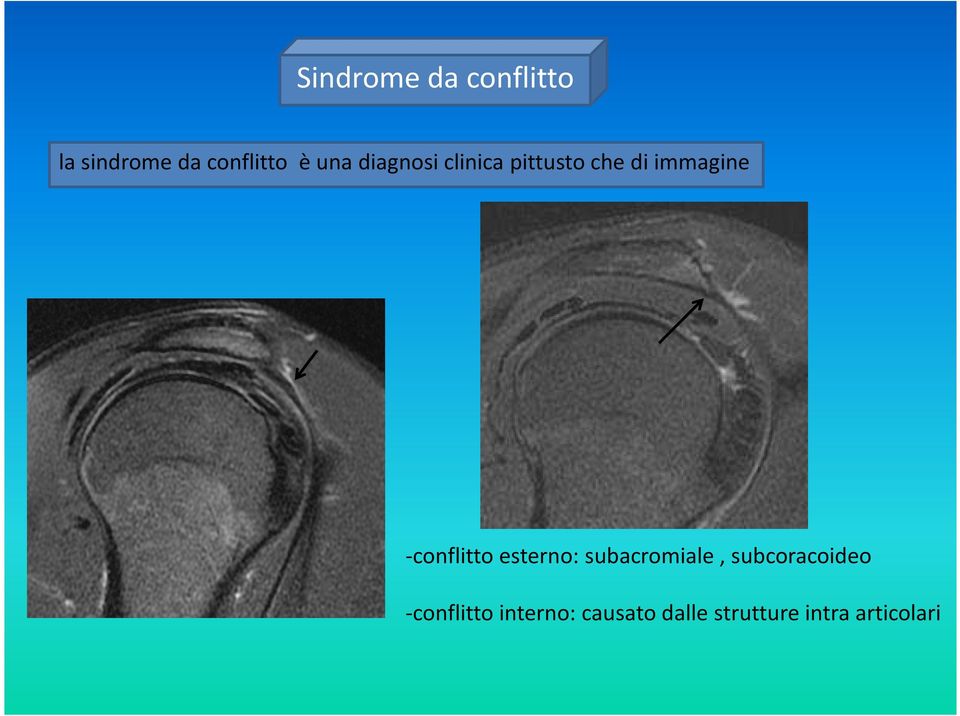 -conflitto esterno: subacromiale, subcoracoideo