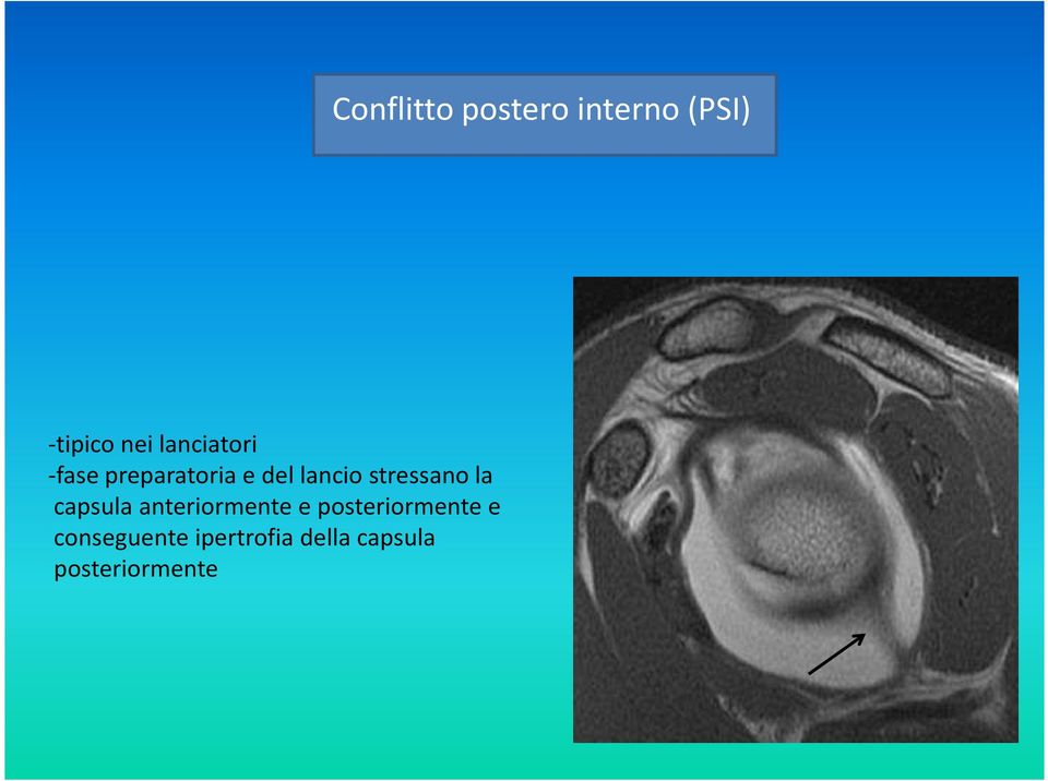 posteriormente e conseguente ipertrofia della