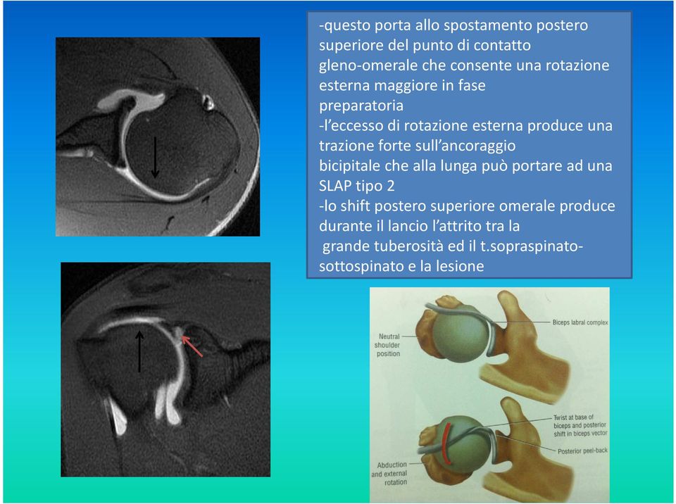 forte sull ancoraggio bicipitaleche alla lunga può portare ad una SLAP tipo 2 -lo shiftpostero superiore