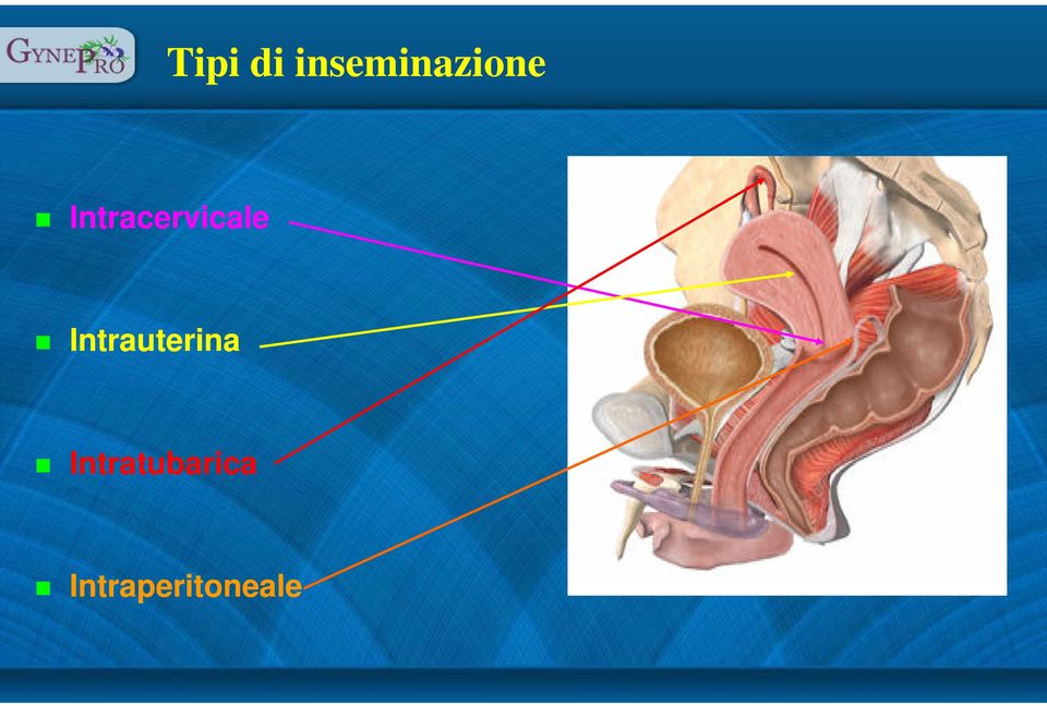 Intracervicale