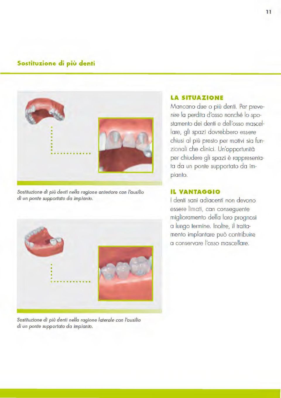 Un'opportunità per chiudere gli spazi è rappresenta ta da un ponte supportato da im pianto. Sostituzione di più denti nello ragione anteriore con l'ausilio di un ponte supporloto do impianto. - l IL!