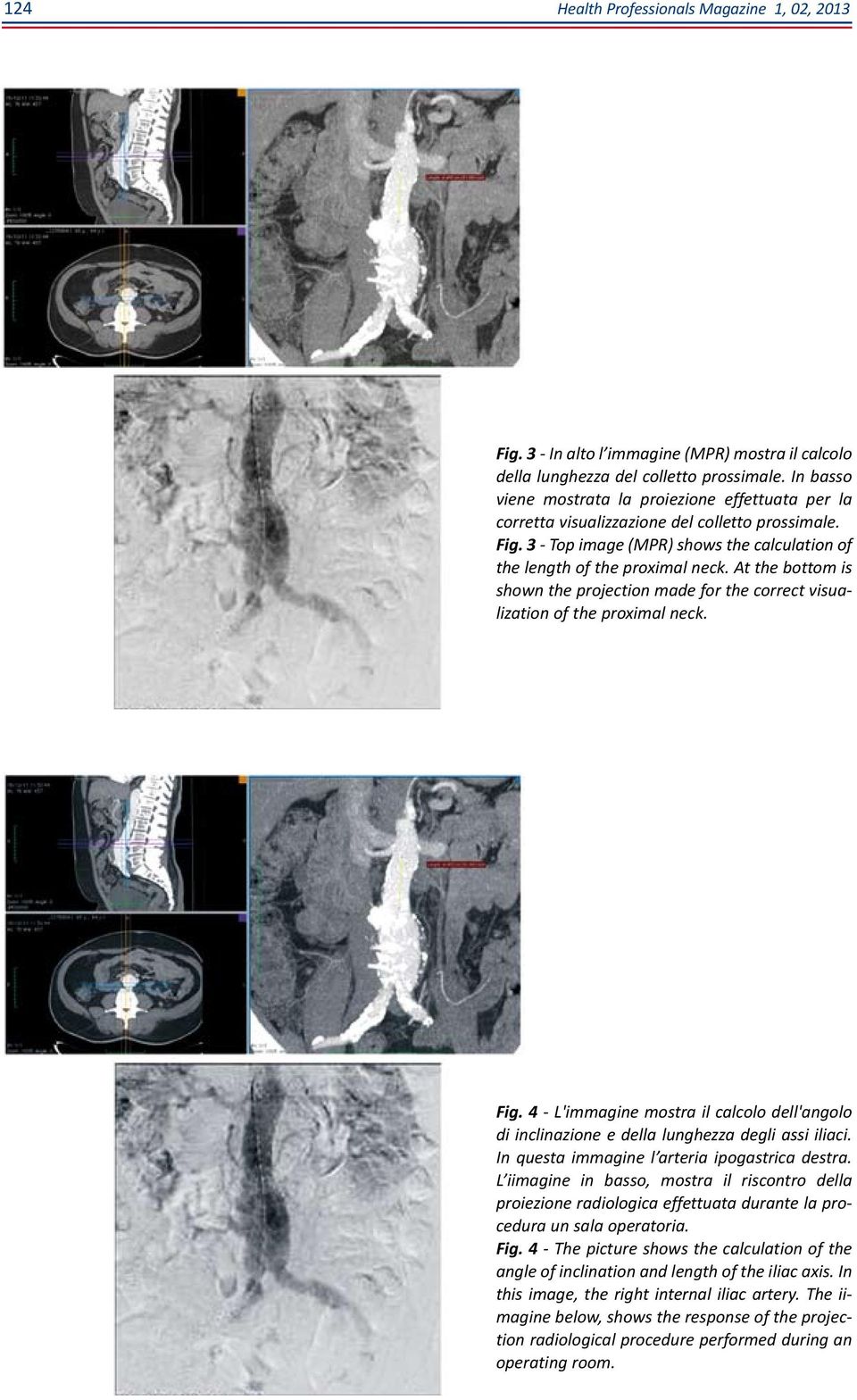 At the bottom is shown the projection made for the correct visualization of the proximal neck. Fig. 4 - L'immagine mostra il calcolo dell'angolo di inclinazione e della lunghezza degli assi iliaci.