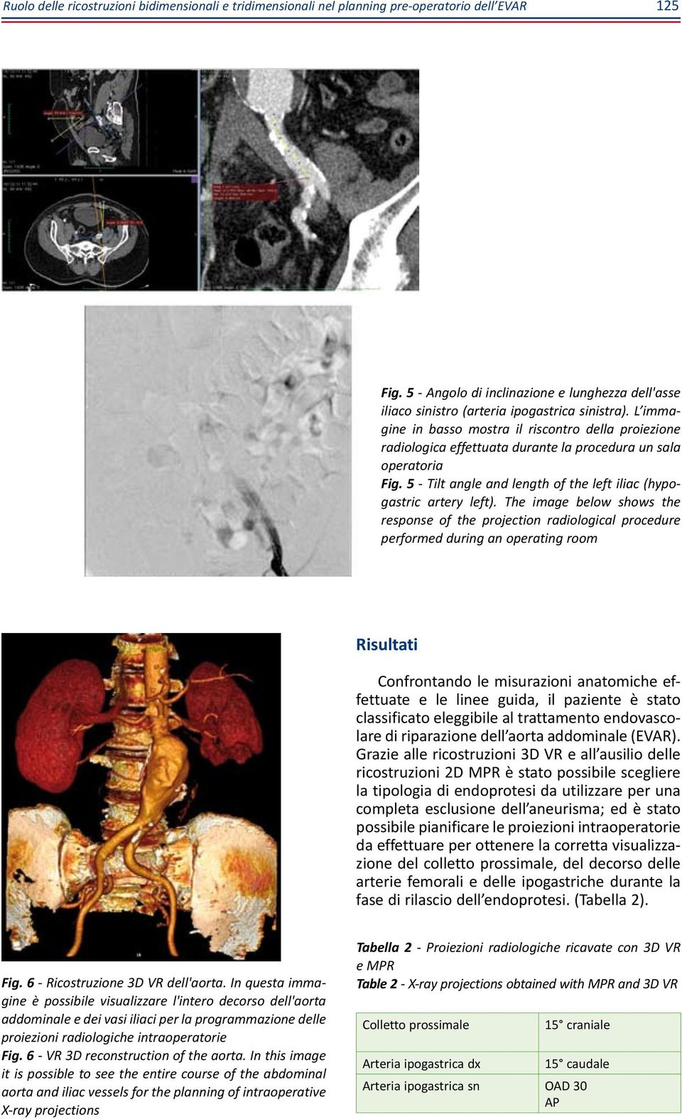 L immagine in basso mostra il riscontro della proiezione radiologica effettuata durante la procedura un sala operatoria Fig. 5 - Tilt angle and length of the left iliac (hypogastric artery left).