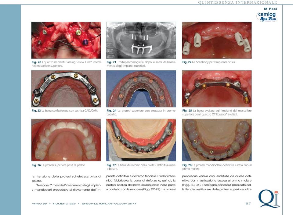 Fig. 27 La barra di rinforzo della protesi definitiva mandibolare. Fig. 26 La protesi superiore priva di palato. la ritenzione della protesi scheletrata priva di palato.