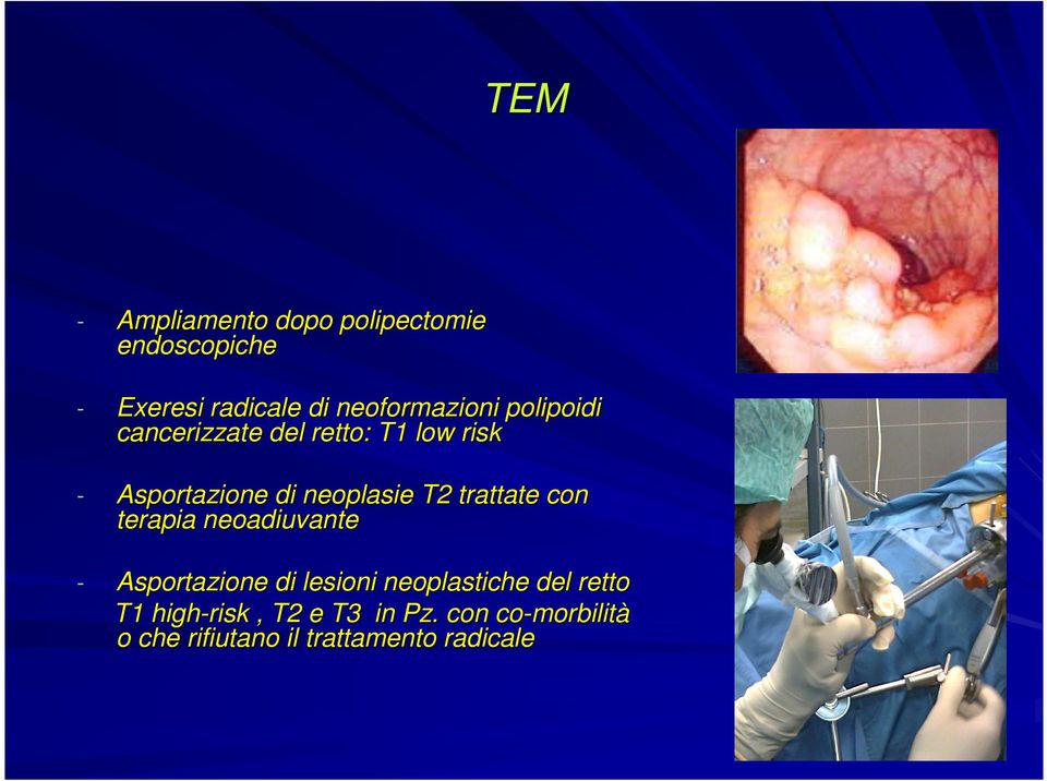 trattate con terapia neoadiuvante - Asportazione di lesioni neoplastiche del retto