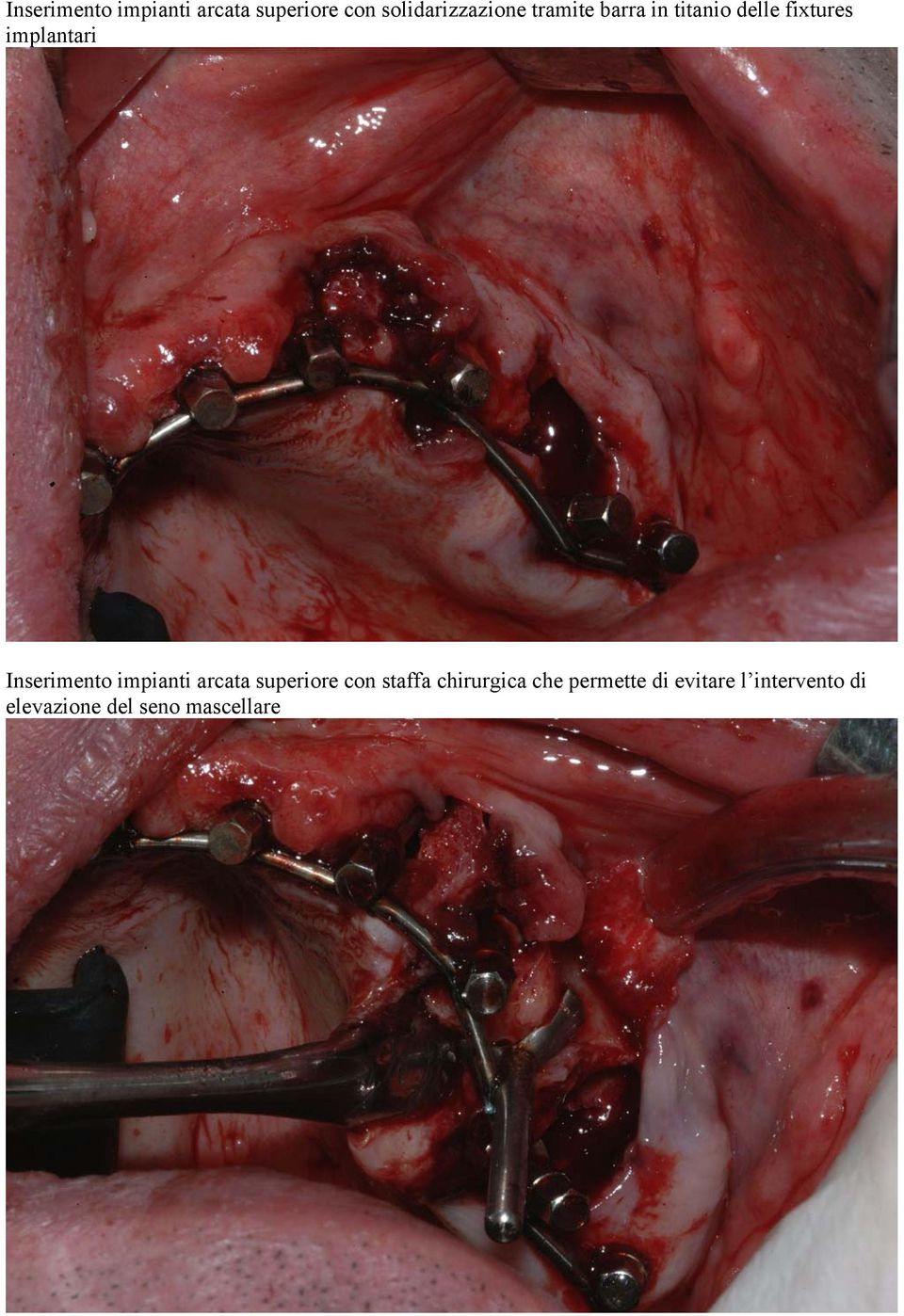 Inserimento impianti arcata superiore con staffa chirurgica