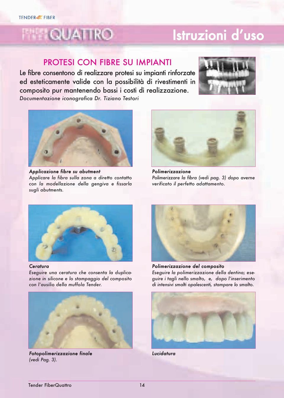 Tiziano Testori Applicazione fibre su abutment Applicare la fibra sulla zona a diretto contatto con la modellazione della gengiva e fissarla sugli abutments.