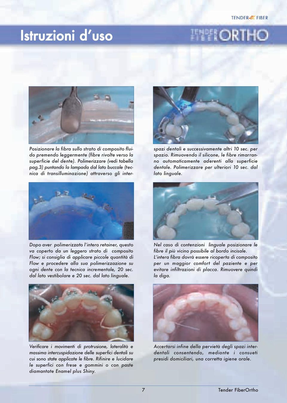 Rimuovendo il silicone, le fibre rimarranno automaticamente aderenti alla superficie dentale. Polimerizzare per ulteriori 10 sec. dal lato linguale.