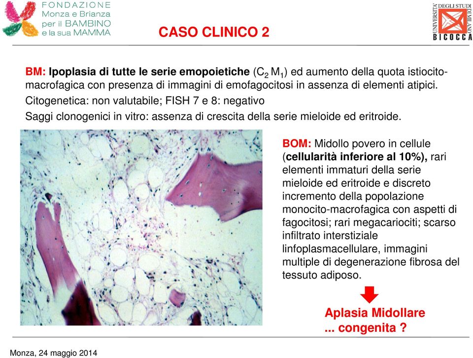 BOM: Midollo povero in cellule (cellularità inferiore al 10%), rari elementi immaturi della serie mieloide ed eritroide e discreto incremento della popolazione monocito-macrofagica