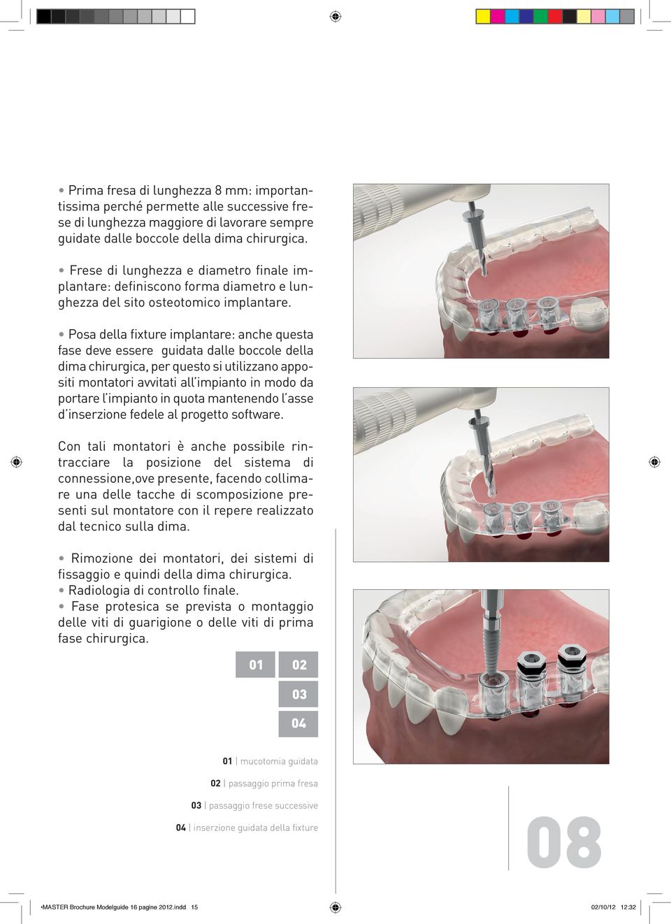 Posa della fixture implantare: anche questa fase deve essere guidata dalle boccole della dima chirurgica, per questo si utilizzano appositi montatori avvitati all impianto in modo da portare l