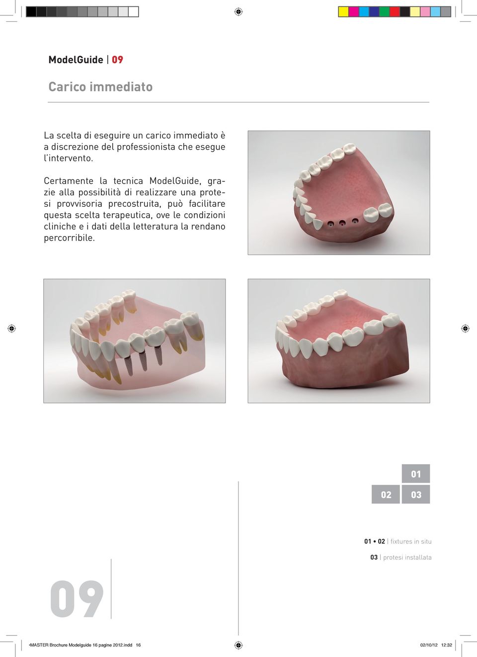 Certamente la tecnica ModelGuide, grazie alla possibilità di realizzare una protesi provvisoria precostruita, può