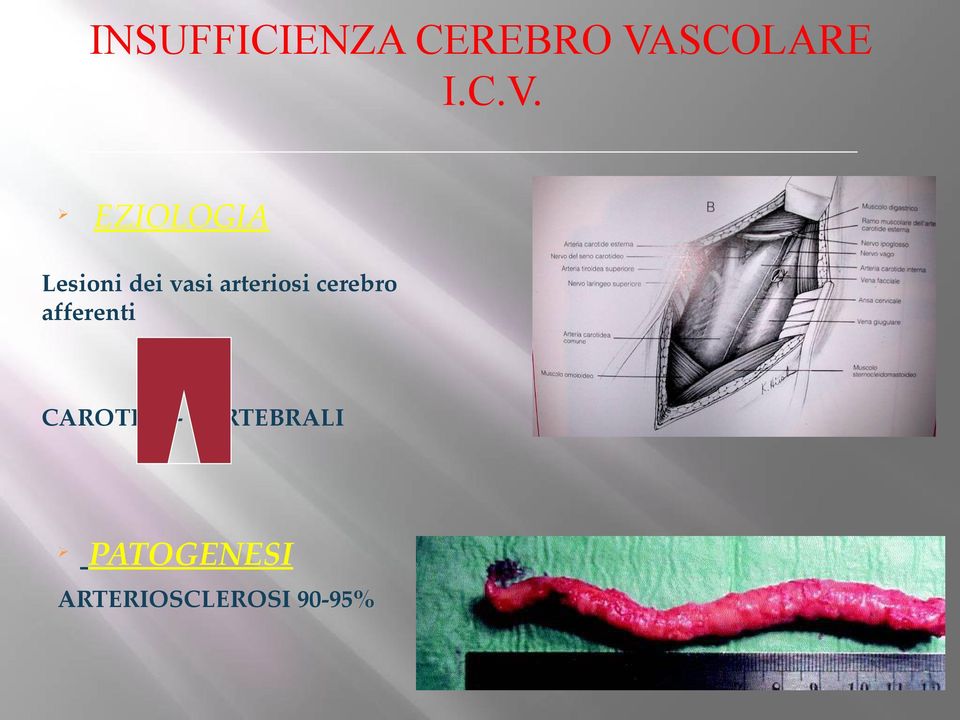 Ø EZIOLOGIA Lesioni dei vasi arteriosi