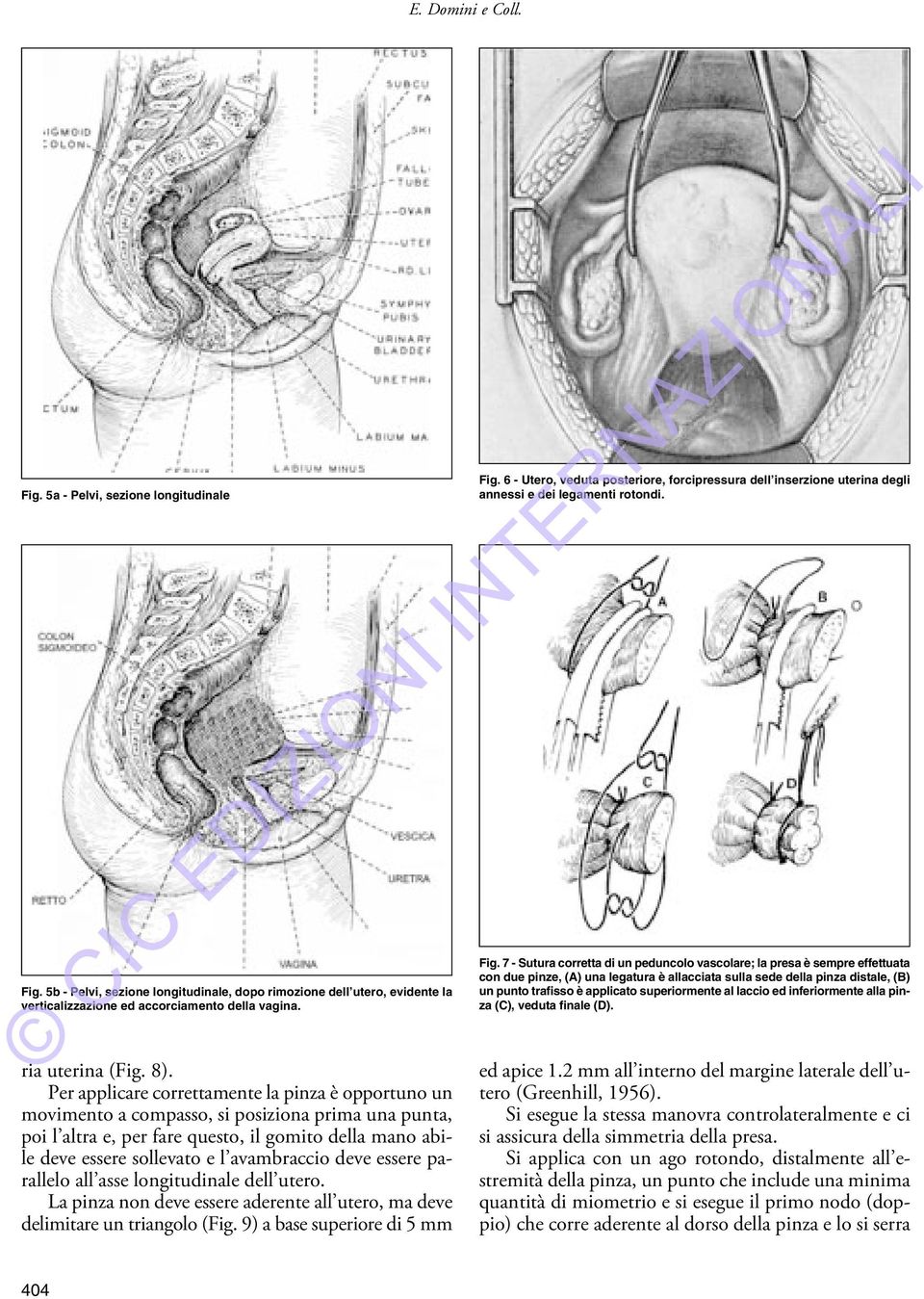 superiormente al laccio ed inferiormente alla pinza (C), veduta finale (D). ria uterina (Fig. 8).