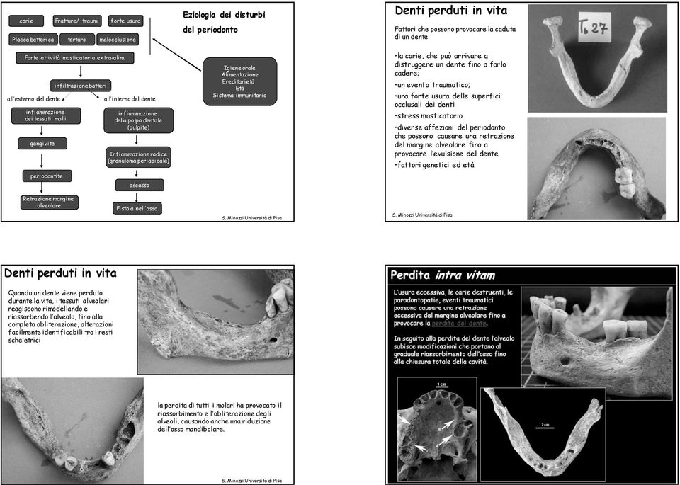 all interno del dente infiammazione della polpa dentale (pulpite) Infiammazione radice (granuloma periapicale) ascesso Eziologia dei disturbi del periodonto Igiene orale Alimentazione Ereditarietà