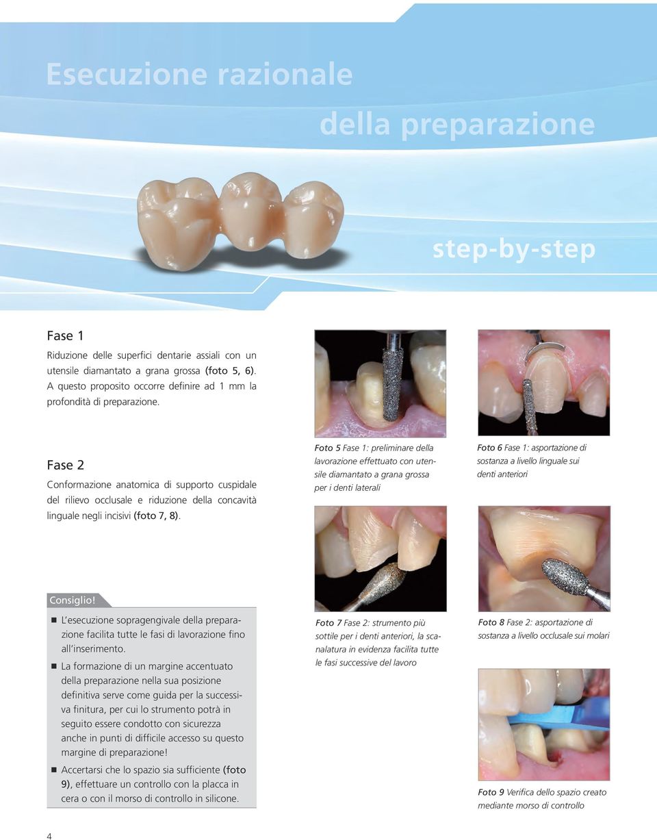 Fase 2 Conformazione anatomica di supporto cuspidale del rilievo occlusale e riduzione della concavità linguale negli incisivi (foto 7, 8).