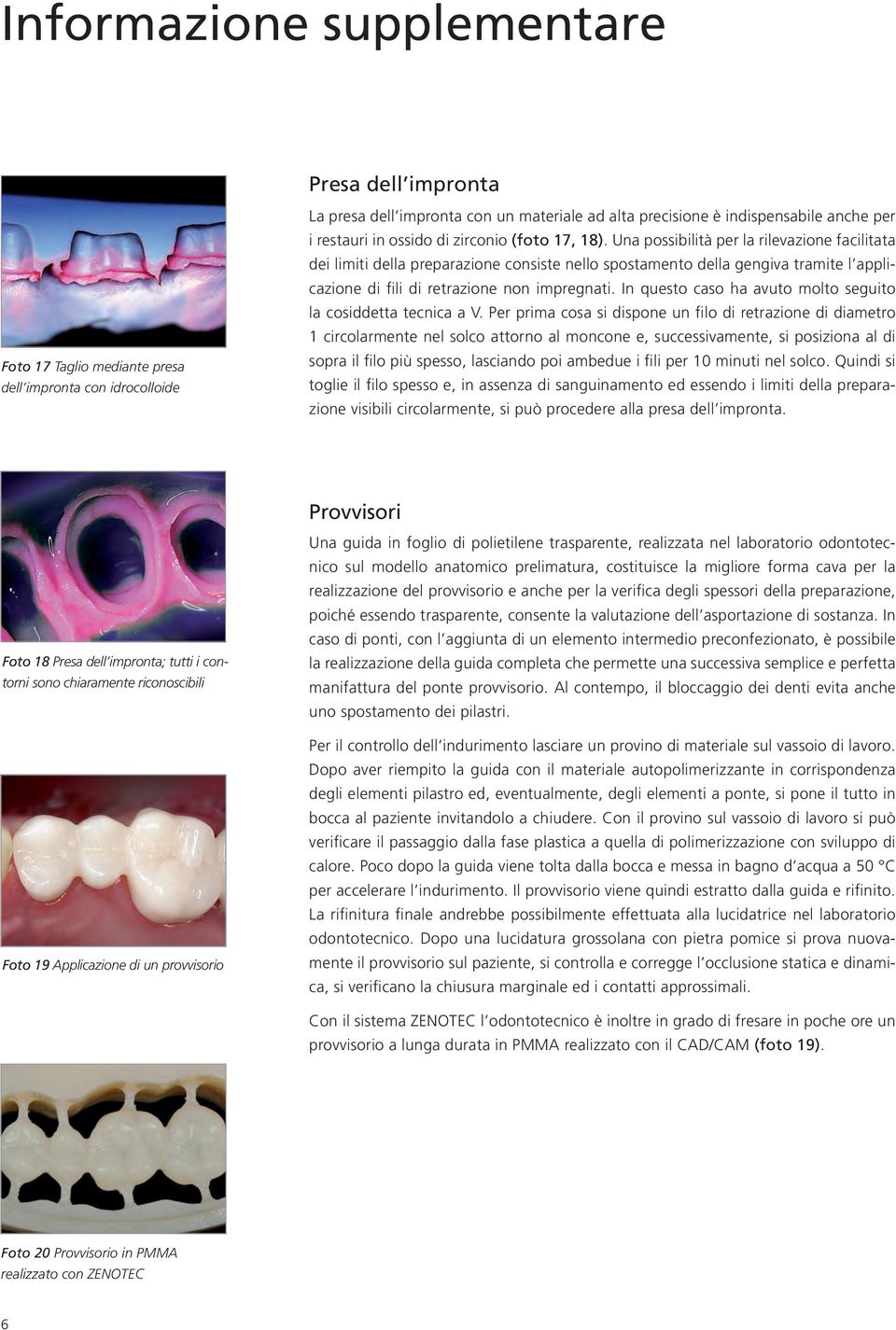 Una possibilità per la rilevazione facilitata dei limiti della preparazione consiste nello spostamento della gengiva tramite l applicazione di fili di retrazione non impregnati.