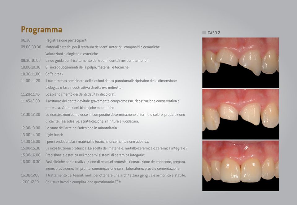 20 Il trattamento combinato delle lesioni dento-parodontali: ripristino della dimensione biologica e fase ricostruttiva diretta e/o indiretta. 11.20-11.