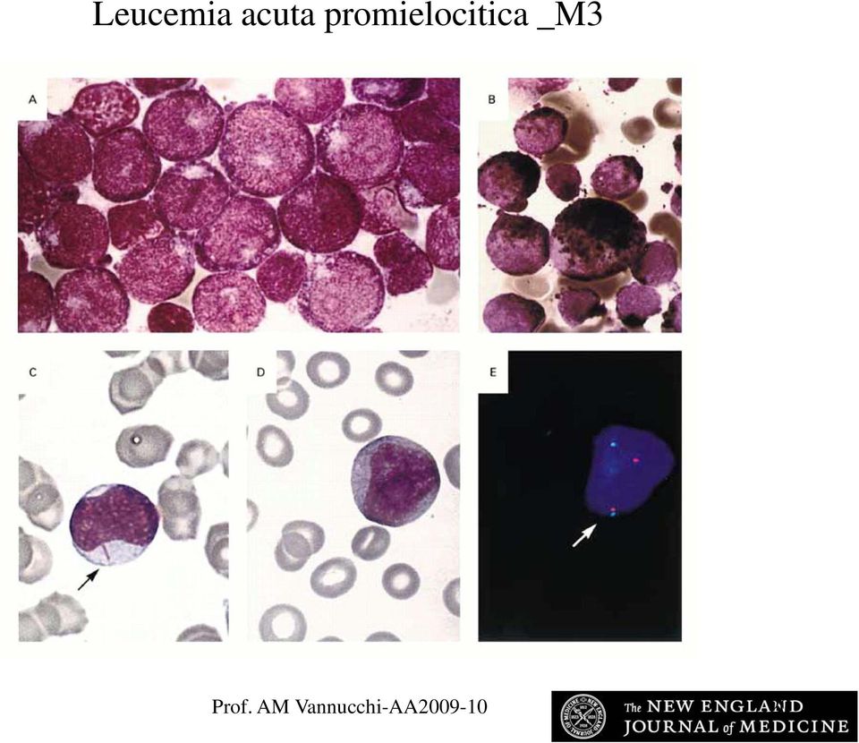 Leucemia M2 AML acuta and the promielocitica