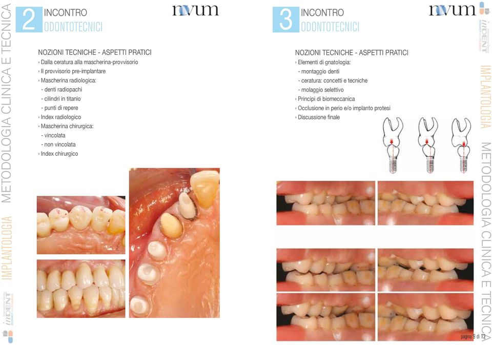 non vincolata Index chirurgico NOZIONI TECNICHE - ASPETTI PRATICI Elementi di gnatologia: - montaggio denti - ceratura:
