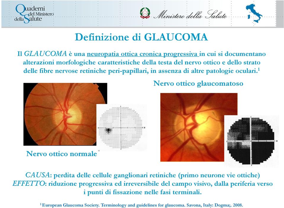 1 Nervo ottico glaucomatoso Nervo ottico normale CAUSA: perdita delle cellule ganglionari retiniche (primo neurone vie ottiche) EFFETTO: riduzione
