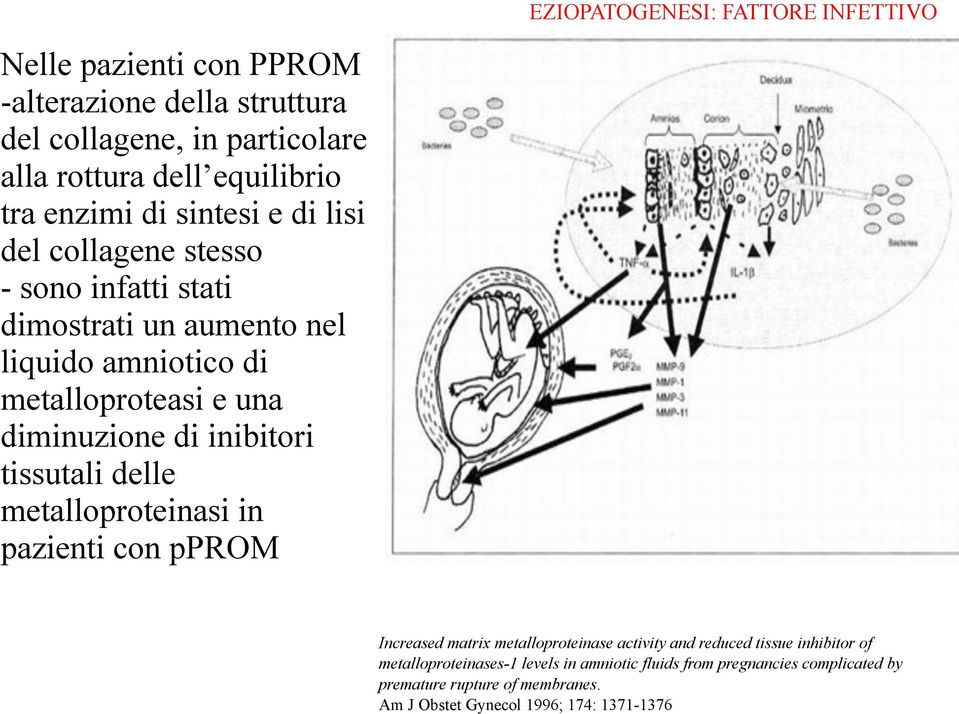 diminuzione di inibitori tissutali delle metalloproteinasi in pazienti con pprom Increased matrix metalloproteinase activity and reduced tissue