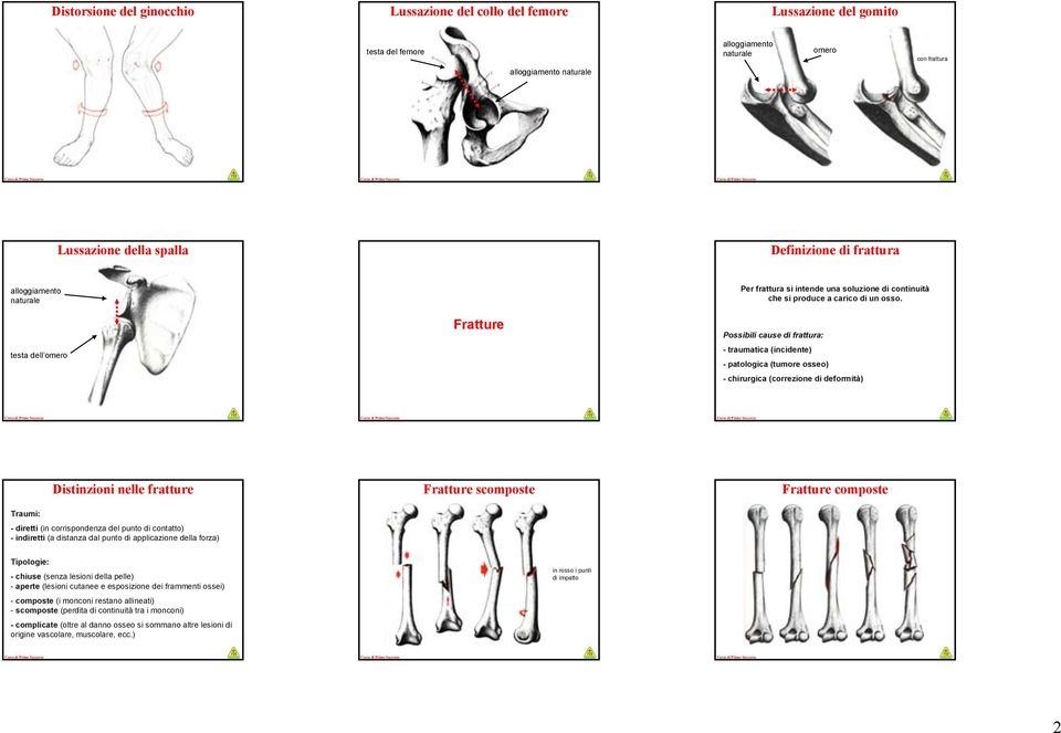 Possibili cause di frattura: - traumatica (incidente) - patologica (tumore osseo) - chirurgica (correzione di deformità) Distinzioni nelle fratture Traumi: - diretti (in corrispondenza del punto di
