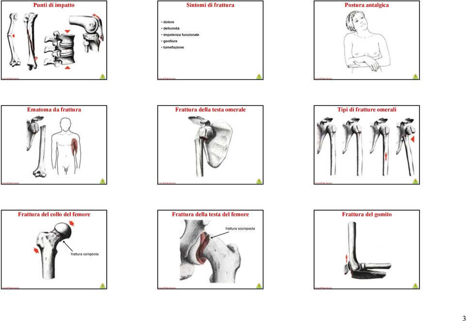 omerale Tipi di fratture omerali Frattura del collo del femore Frattura