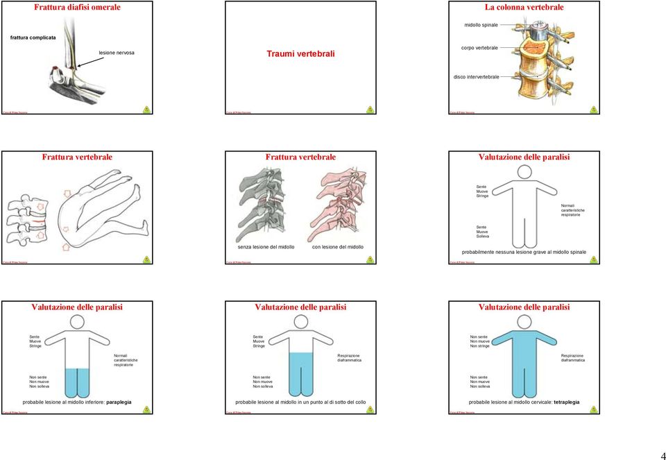 midollo spinale Valutazione delle paralisi Valutazione delle paralisi Valutazione delle paralisi Sente Muove Stringe Normali caratteristiche respiratorie Sente Muove Stringe Respirazione