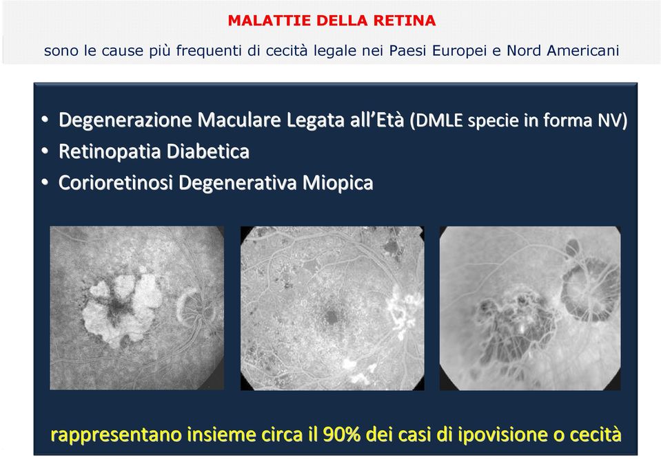 (DMLE specie in forma NV) Retinopatia Diabetica Corioretinosi