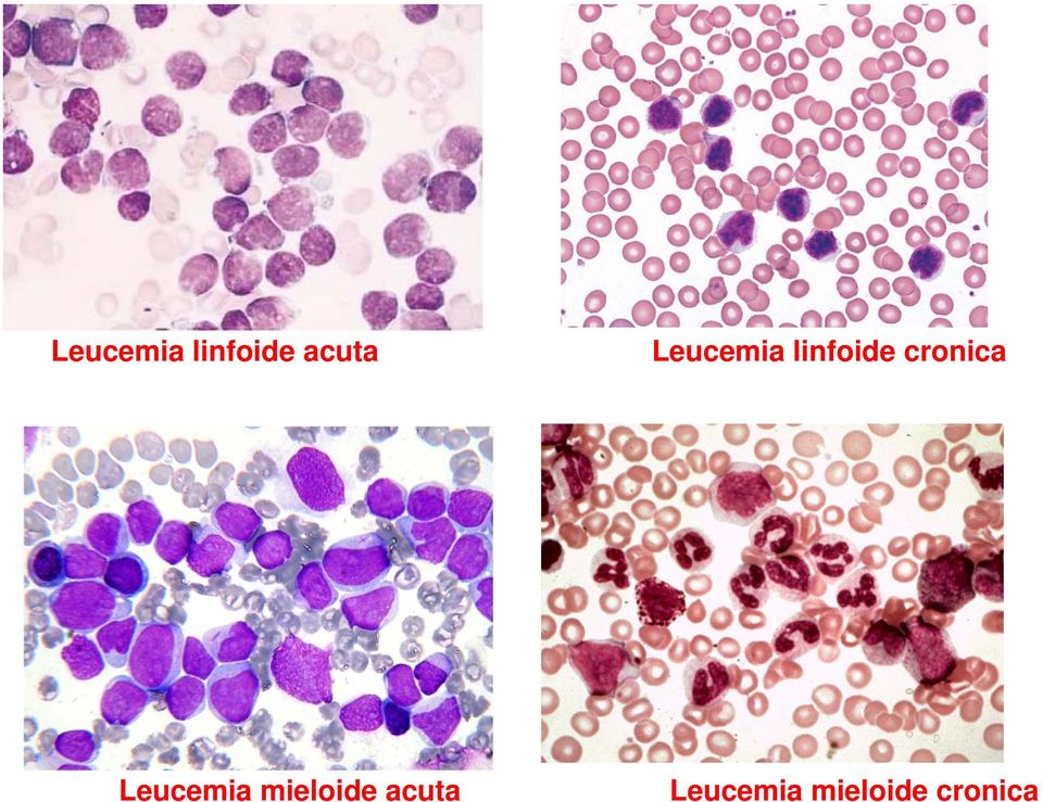 cronica Leucemia