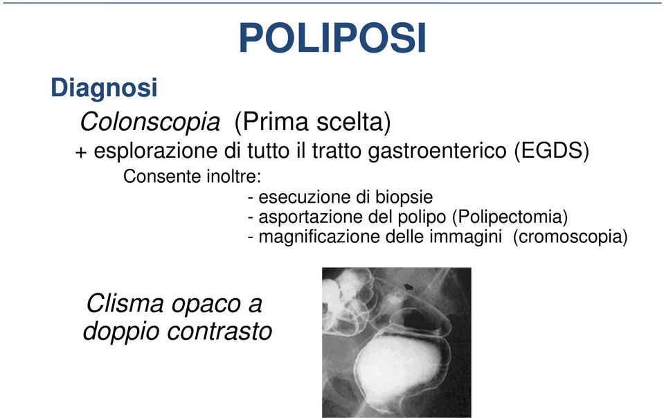 biopsie - asportazione del polipo (Polipectomia) -magnificazione