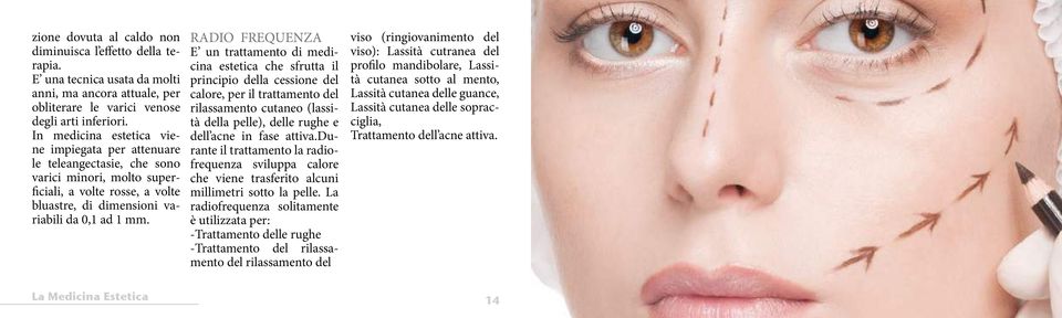 RADIO FREQUENZA E un trattamento di medicina estetica che sfrutta il principio della cessione del calore, per il trattamento del rilassamento cutaneo (lassità della pelle), delle rughe e dell acne in