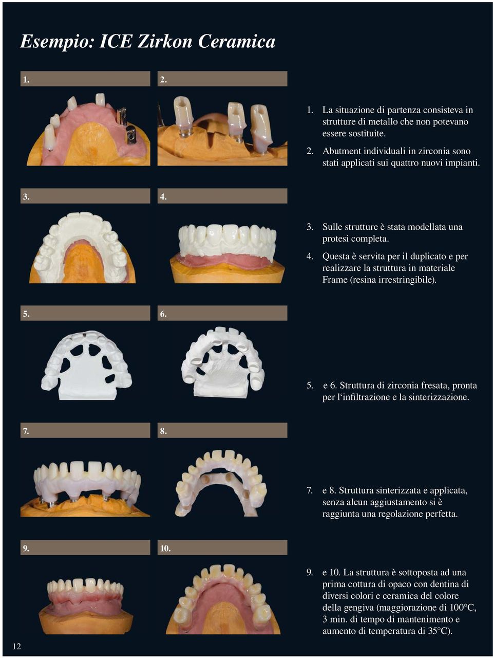 Struttura di zirconia fresata, pronta per l infiltrazione e la sinterizzazione. 7. 8. 7. e 8. Struttura sinterizzata e applicata, senza alcun aggiustamento si è raggiunta una regolazione perfetta. 9.