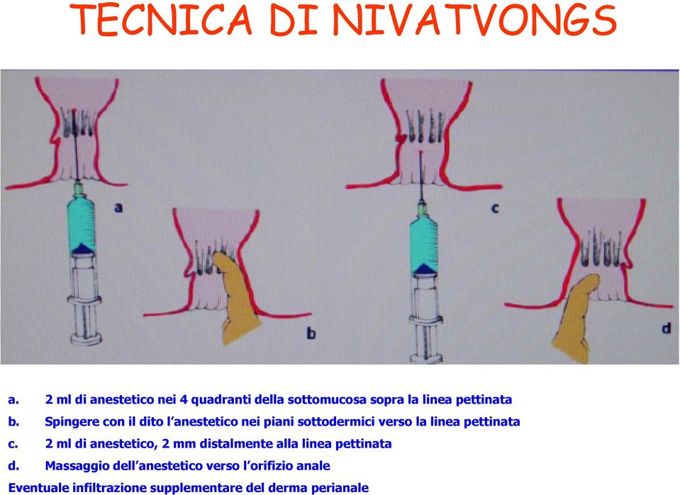 Spingere con il dito l anestetico nei piani sottodermici verso la linea pettinata c.