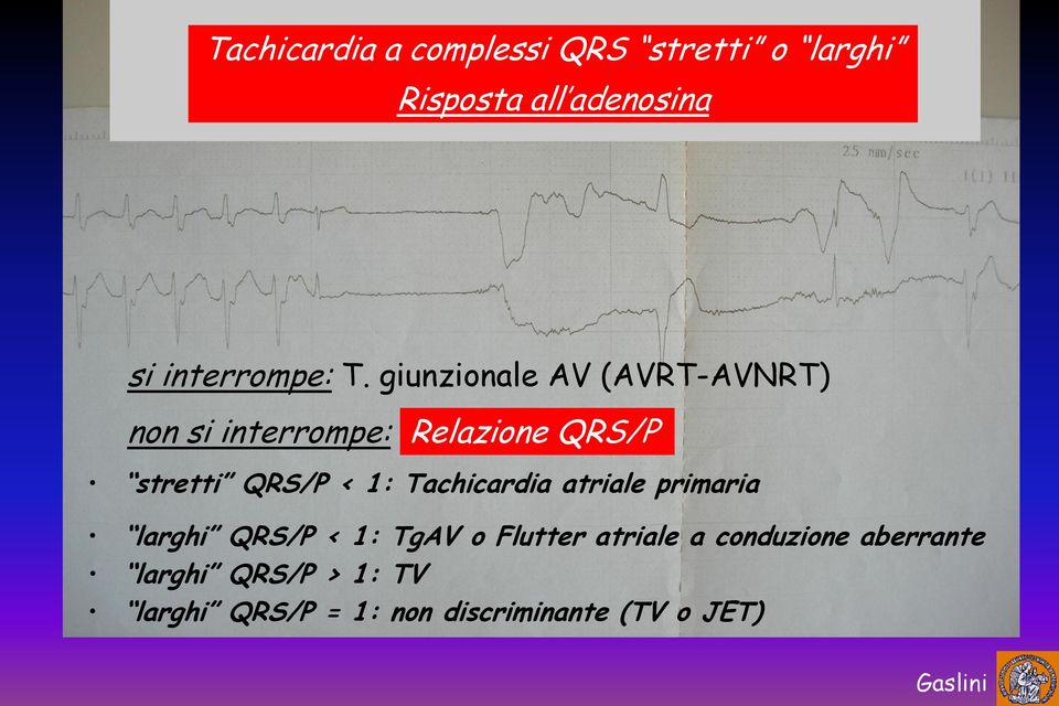 giunzionale AV (AVRT-AVNRT) non si interrompe: Relazione QRS/P stretti QRS/P < 1: