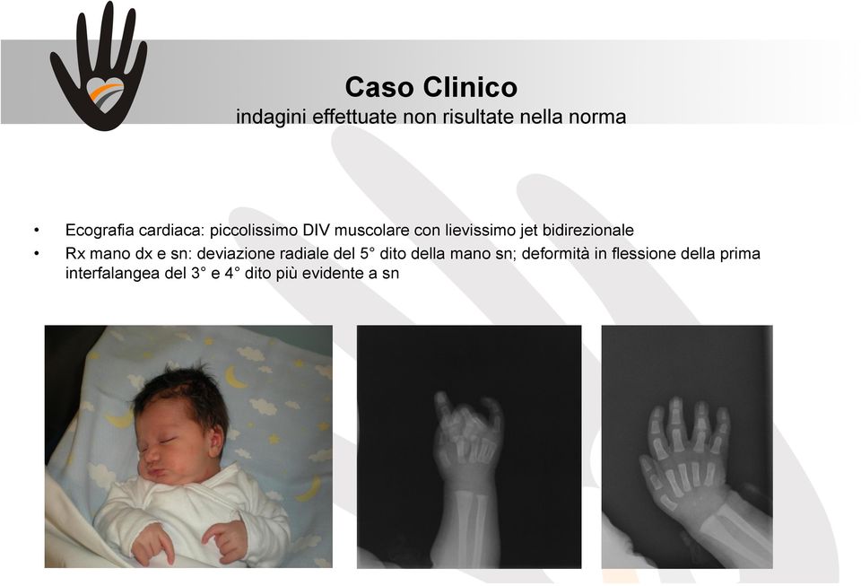 Rx mano dx e sn: deviazione radiale del 5 dito della mano sn;